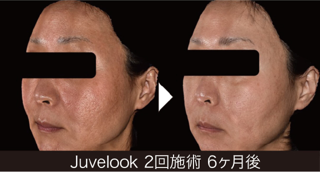 ジュベルックの症例写真2