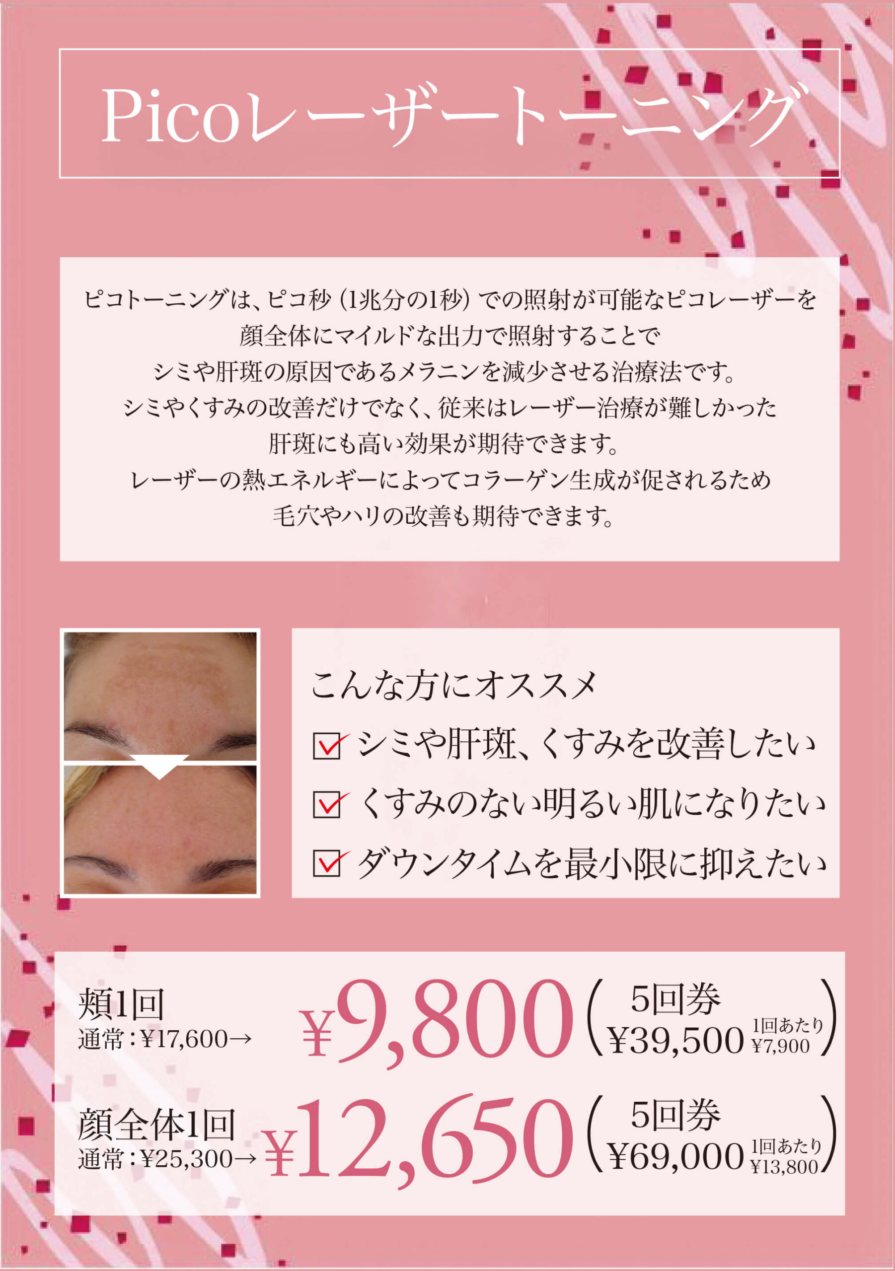 ピコレーザートーニング,肝斑治療,シミ治療,美白治療