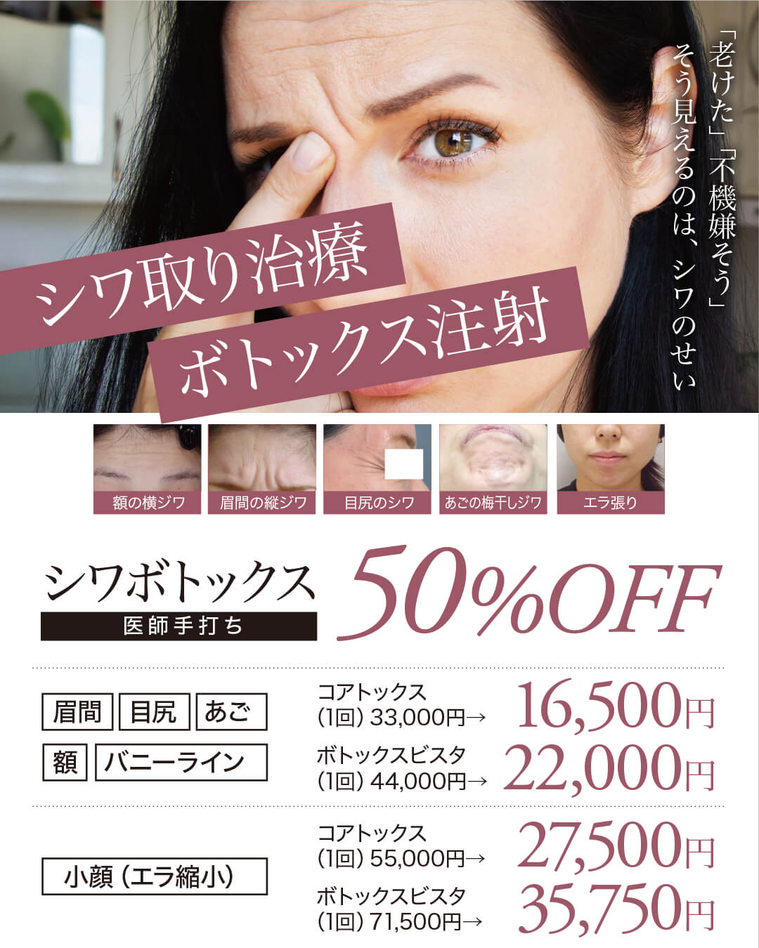 シワ治療,ボトックス注射