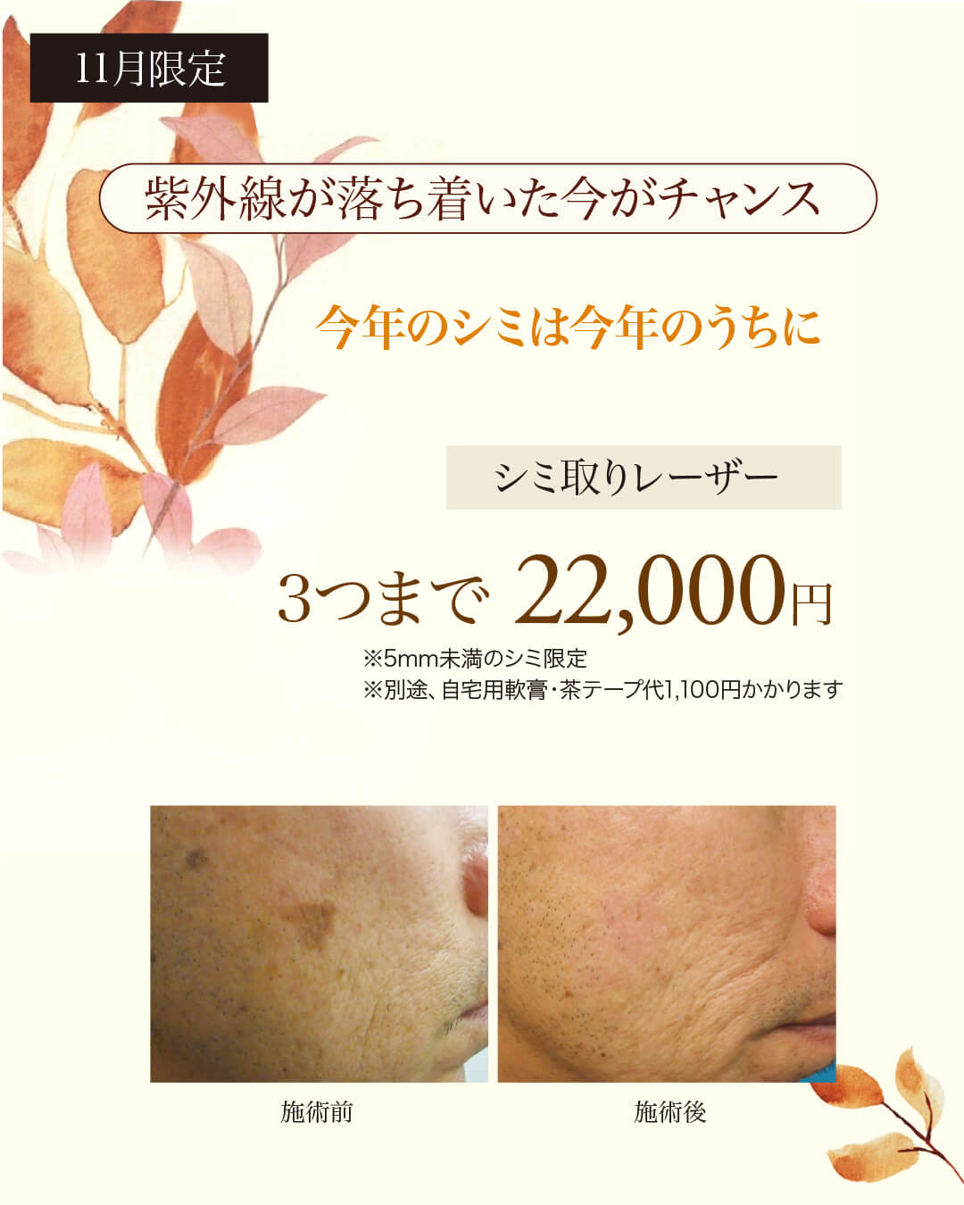 シミ取りレーザー,ピコレーザー