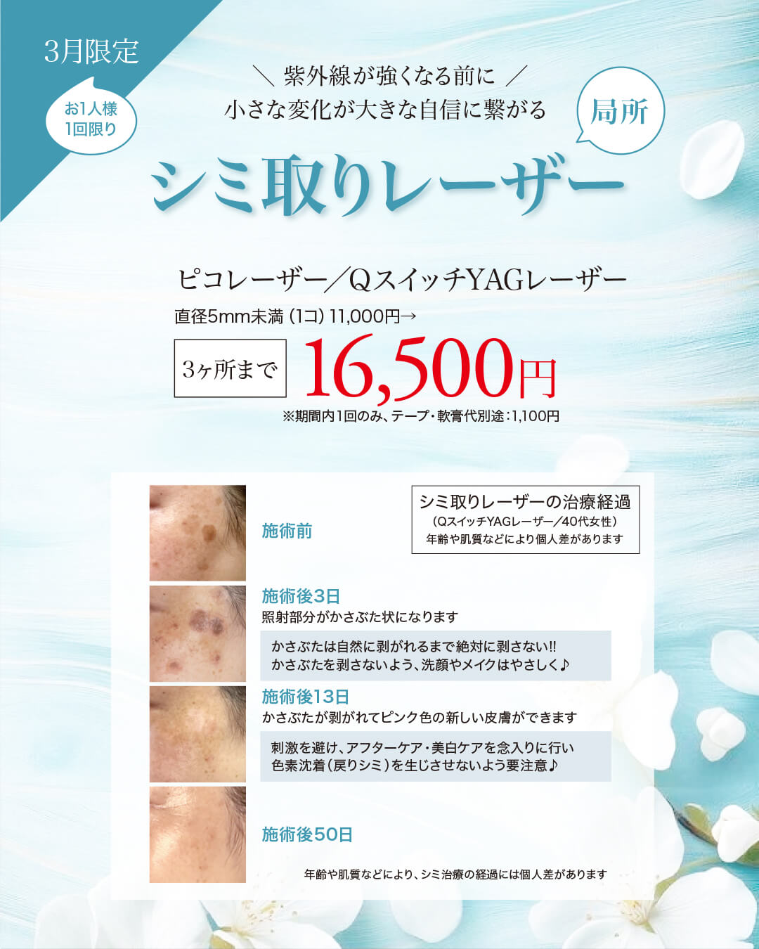 シミ取りレーザー,ピコレーザー,QスイッチYAGレーザー